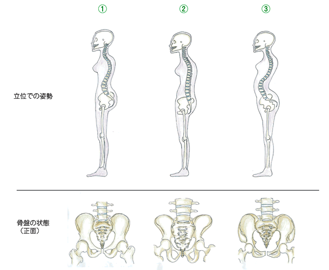 骨盤が後傾していることが原因