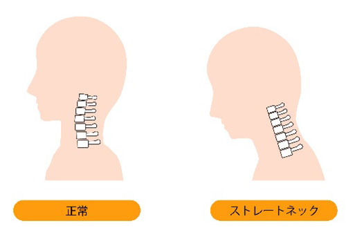 寝違えを繰り返してしまうわけ